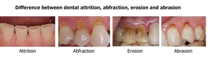 abrasion, abfraction, attrition, erosion 2 Quiz