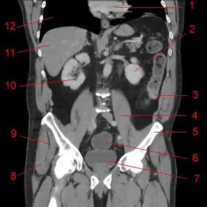 CT Abdomen Axial Anatomy Quiz