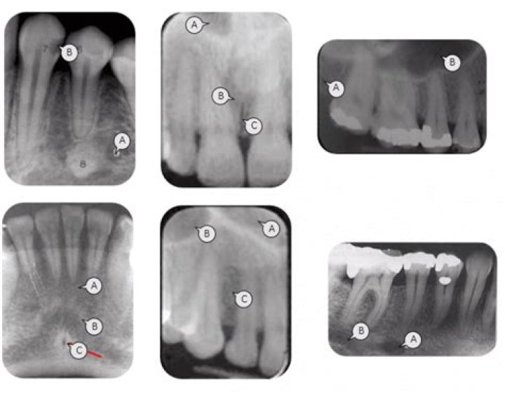 Dental X-ray Landmarks 3 Quiz