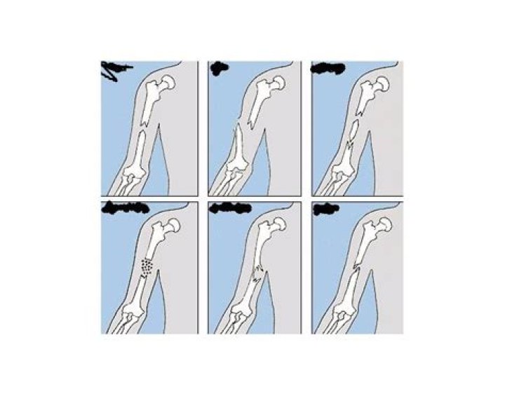 Name that Fracture Quiz